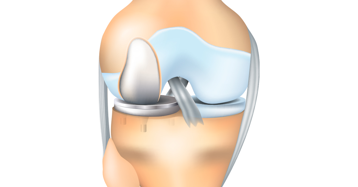 ConforMIS Custom Partial Knee Replacement Lake Charles, LA