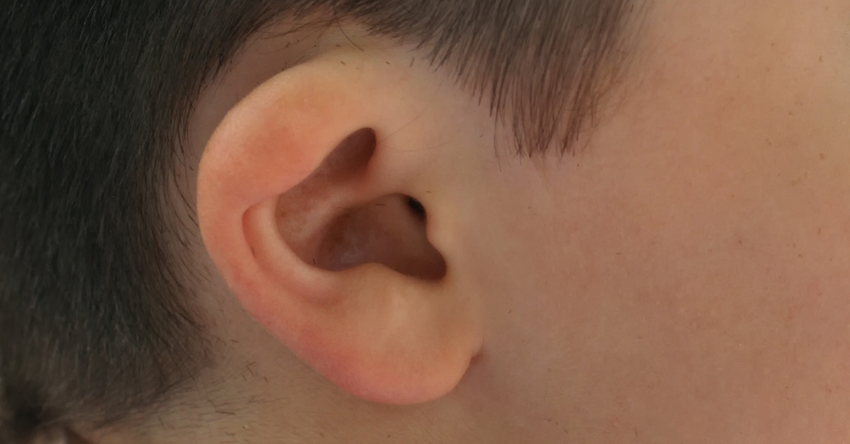 Congenital Ear Deformities Alabama Nasal and Sinus Center, Birmingham
