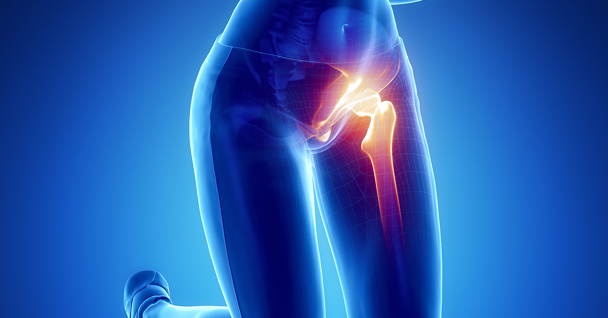 Hip Treatments Ocala, FL Dr. Karl Siebuhr, MD Orthopedic Surgeon