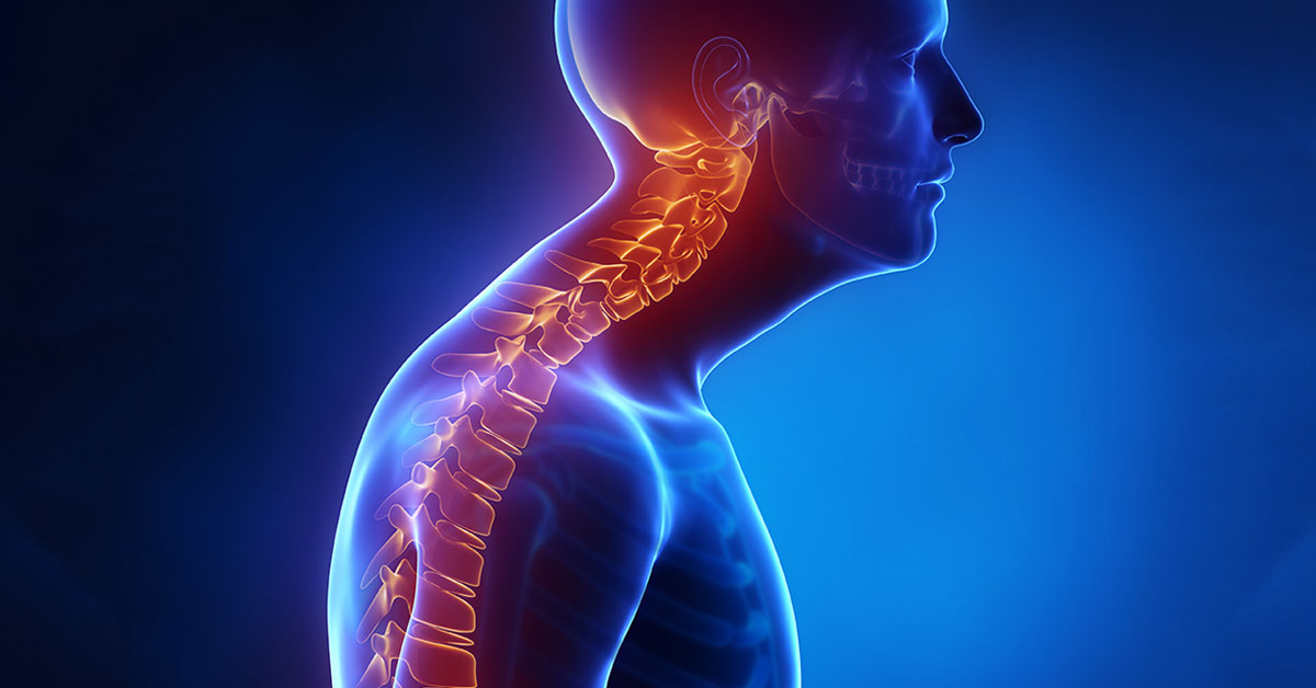 Kyphosis Atlanta, GA Spine Surgery