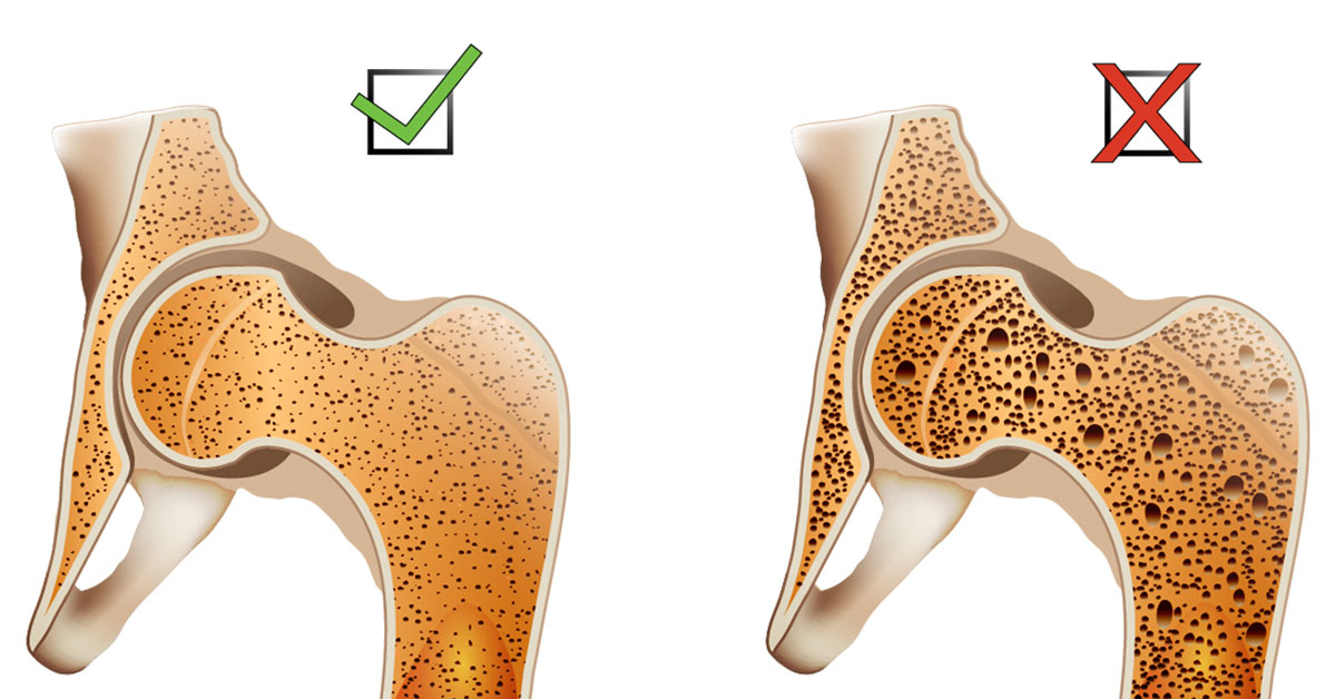 Osteoporosis Scottsdale, AZ Orthopedic Spine Surgery