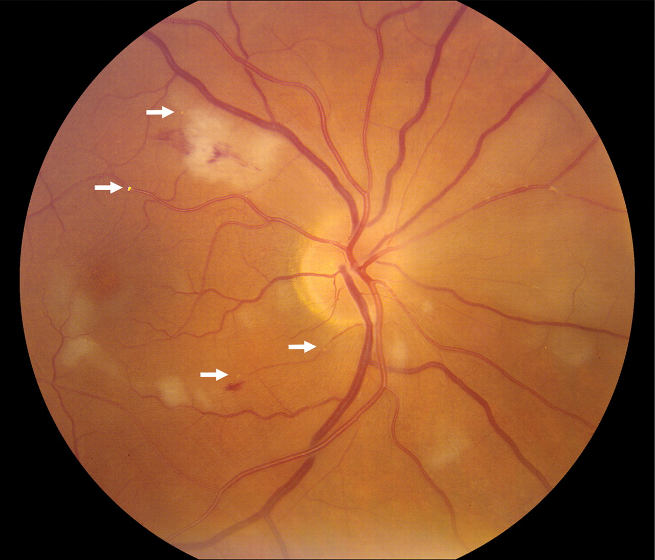 Multiple retinal emboli in a case of acute stroke Abdulkarim et al. 11 (1) 42 Practical