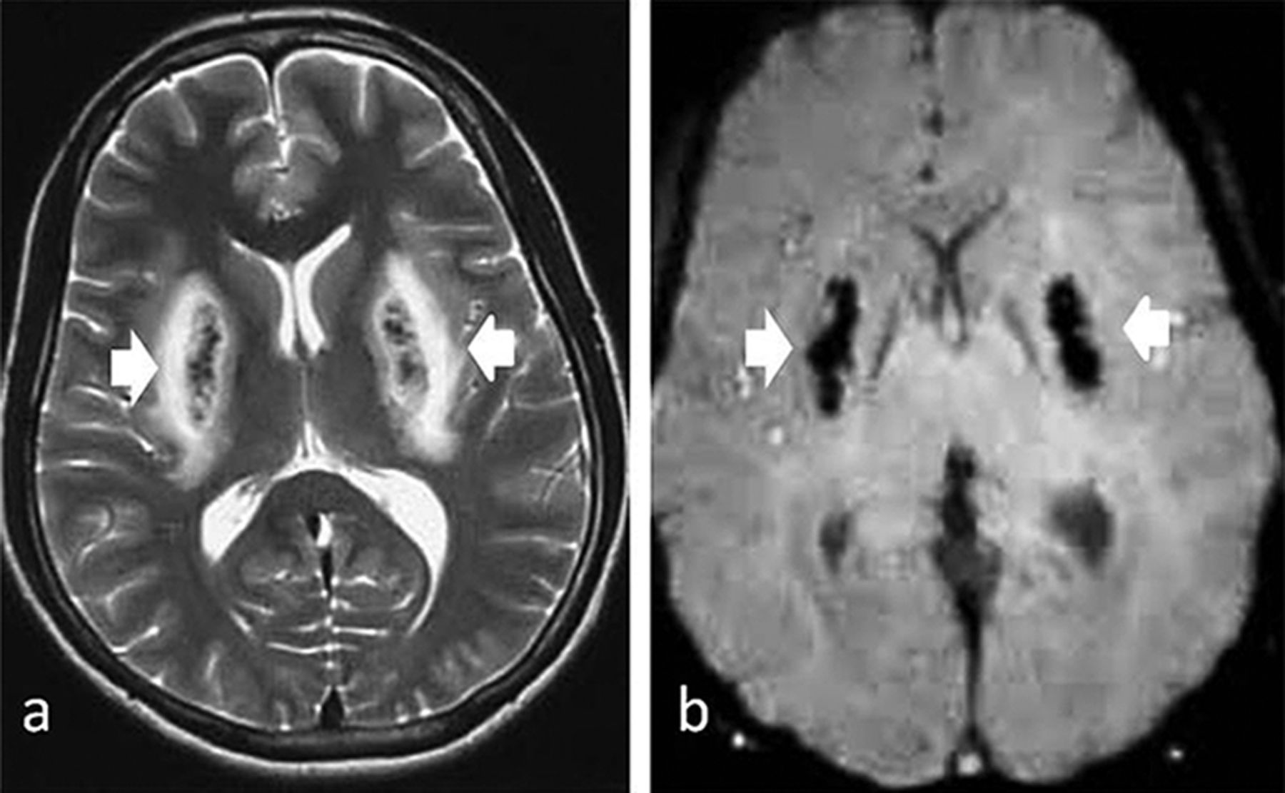 Methanol toxicity presenting as haemorrhagic putaminal necrosis and