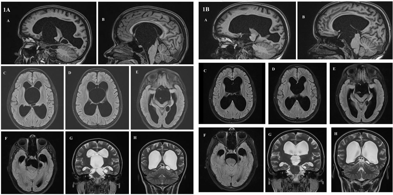 Bobblehead doll syndrome with suprasellar arachnoid cyst Practical Neurology