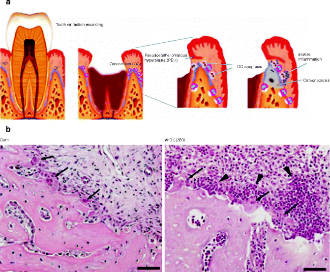 Bisphosphonates and Dental Implant Treatment Pocket Dentistry