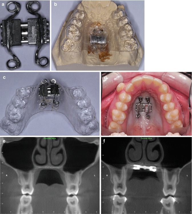 BoneAnchored Rapid Palatal Expansion Pocket Dentistry