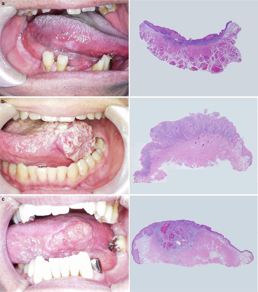 Surgical Pathology of Oral Cancer Pocket Dentistry