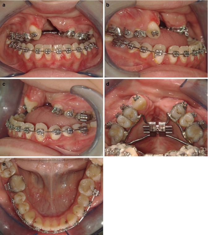 Archwise Distraction Appliance (AWDA) in Cleft Lip and Palate Patient