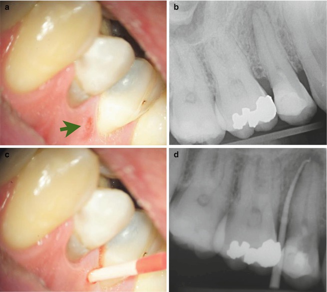Endodontic Emergencies Pocket Dentistry