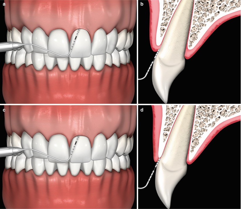 Esthetical Clinical Crown Lengthening, Lip Repositioning, and Gingival