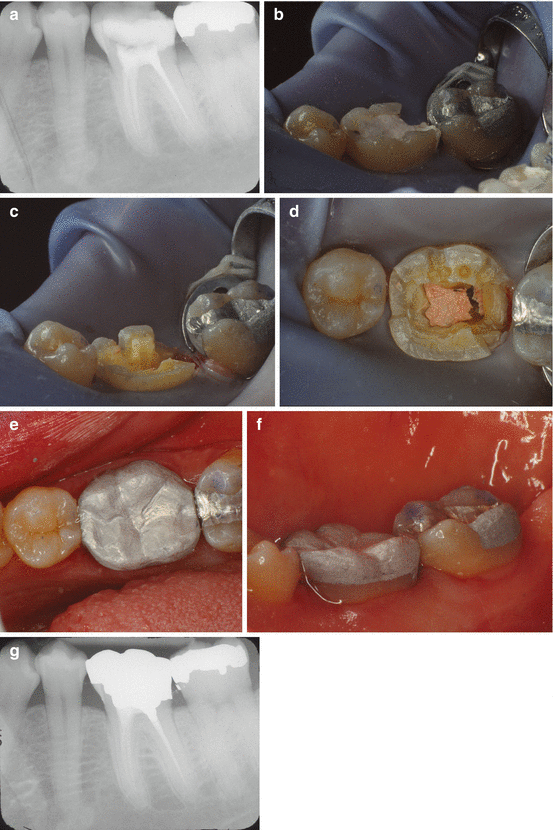 Endodontic Considerations for the Restoration of Endodontically Treated