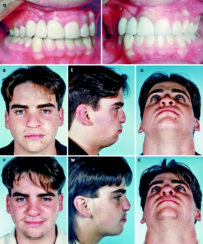 Protraction Facial Mask Pocket Dentistry