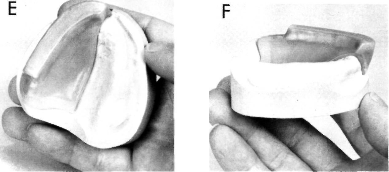 Occlusion Rims, Pocket Dentistry