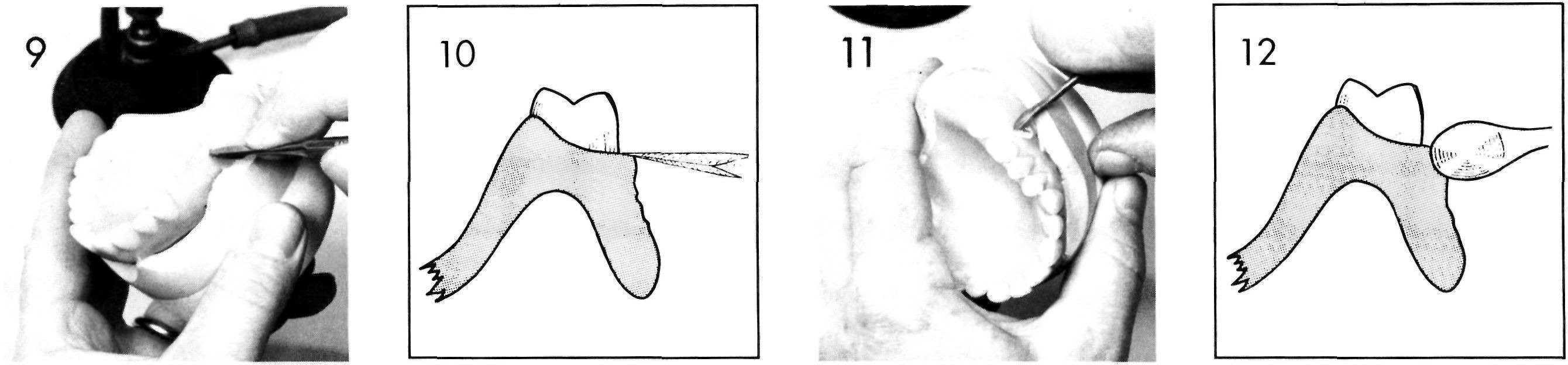 Festooning, Pocket Dentistry