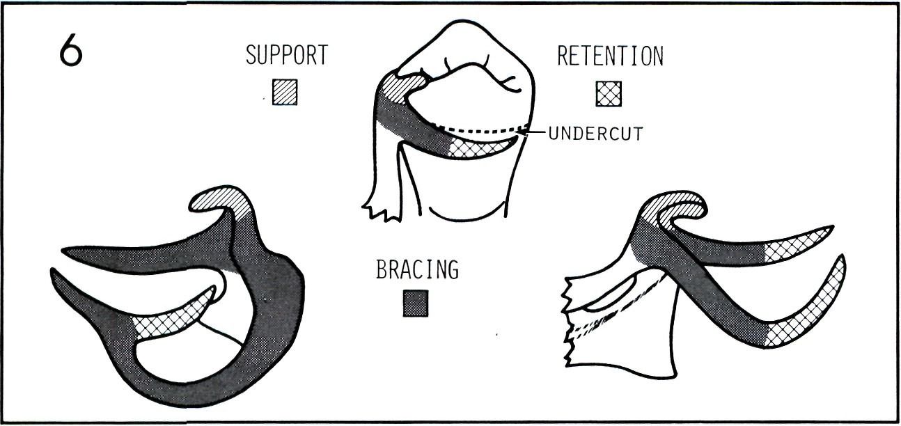 Partial Denture Clasp Types