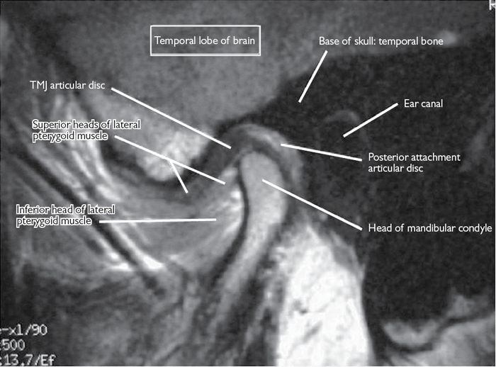 The temporomandibular joint Pocket Dentistry