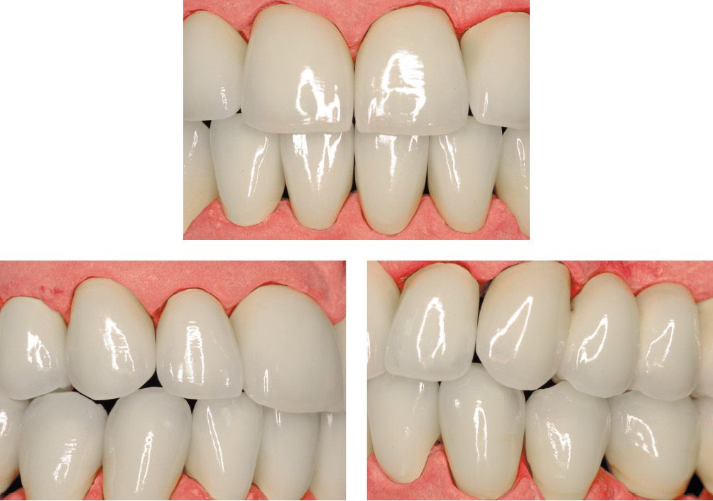 THE DIODE LASER IN FIXED PROSTHETIC RESTORATIONS AIMS AND POTENTIAL