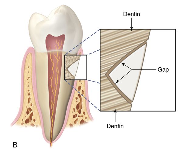 Composite resin Fundamentals and direct technique restorations