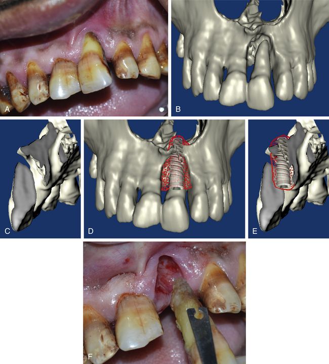 Nasal floor elevation and grafting Pocket Dentistry