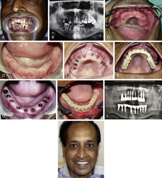 Fullarch fixed prosthesis conventional approach Pocket Dentistry
