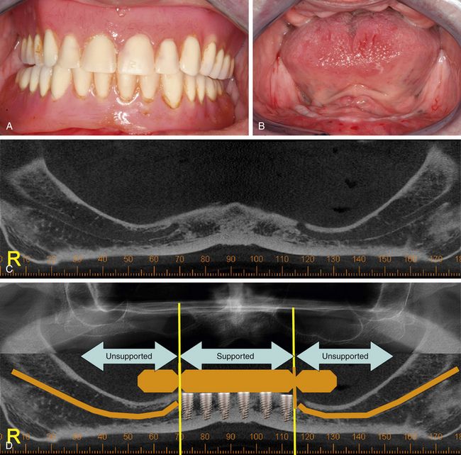 Fullarch fixed prosthesis conventional approach Pocket Dentistry