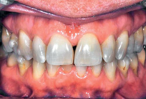 Bleaching and related agents Pocket Dentistry