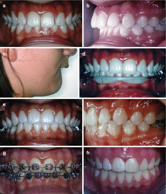 Treatment Options, Timing and Sequencing Orthodontics Pocket Dentistry