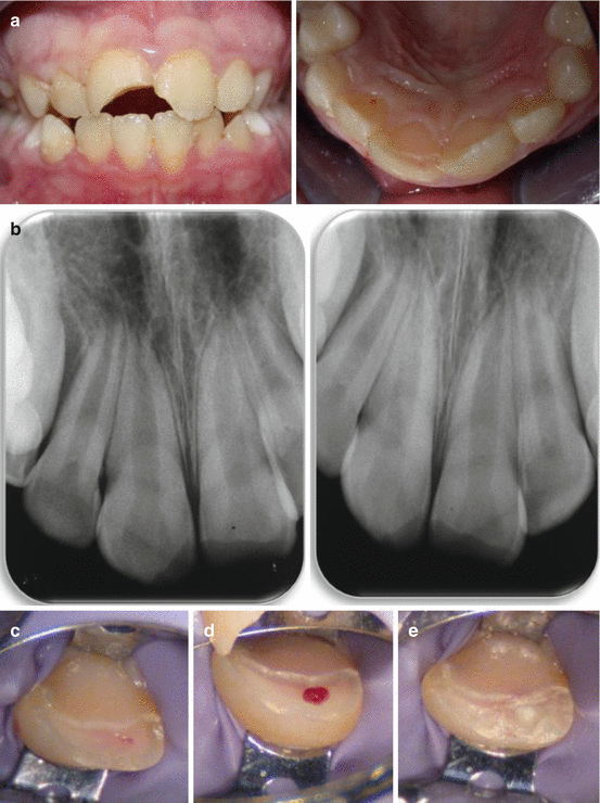 Pulp Therapy for the Young Permanent Dentition Pocket Dentistry