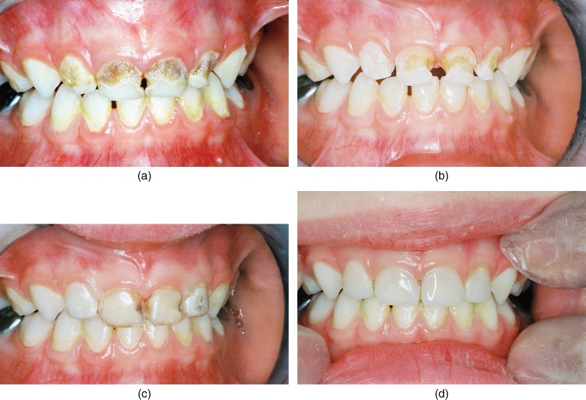 Primary incisor restoration Pocket Dentistry