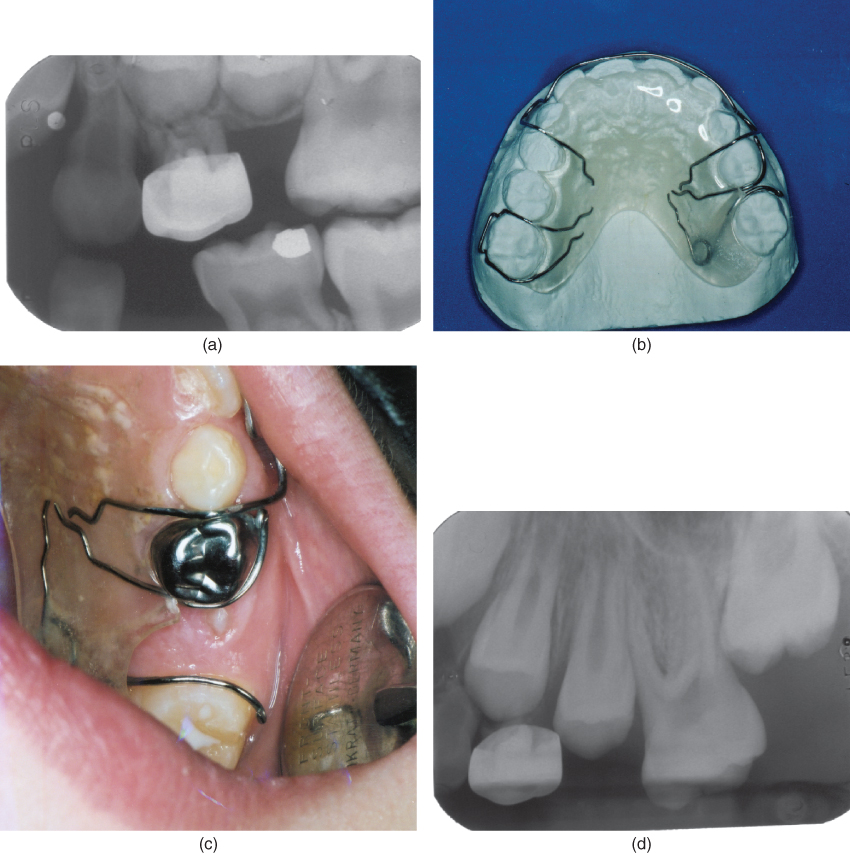 Ectopic eruption of maxillary first permanent molar Pocket Dentistry