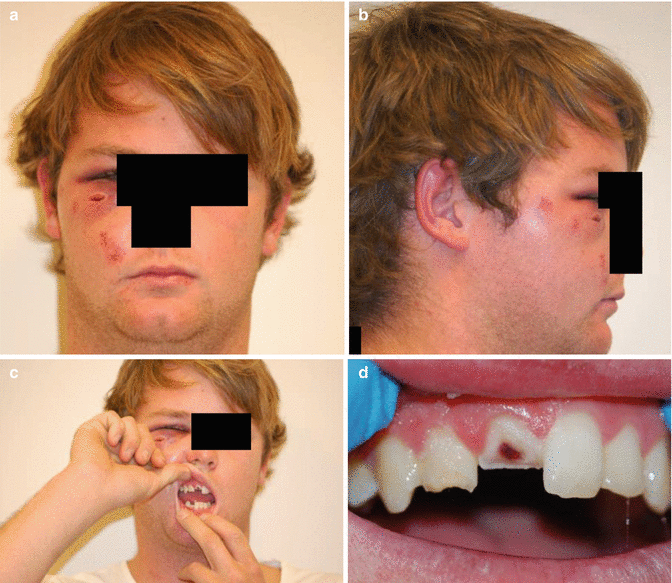 Traumatic Injuries Pocket Dentistry