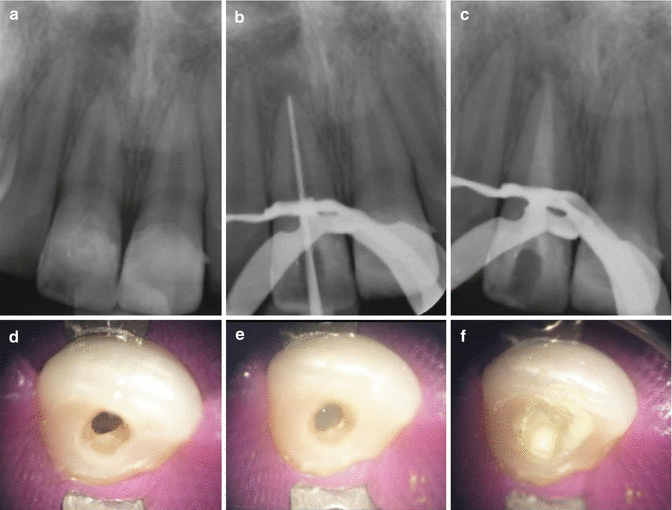 Apexogenesis, Apexification, Revascularization and Endodontic