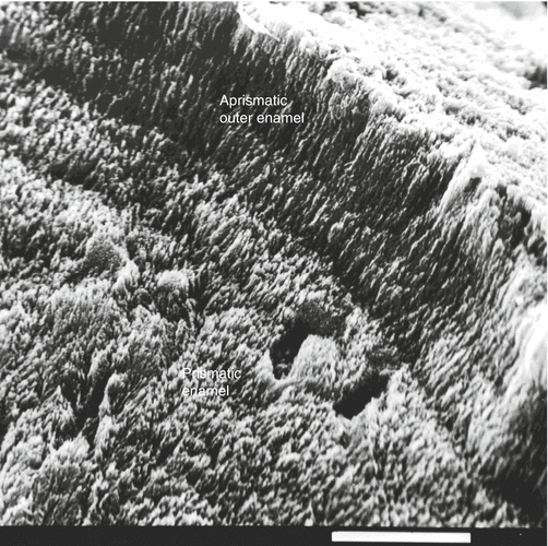 Enamel Softening (Dental Erosion) Pocket Dentistry