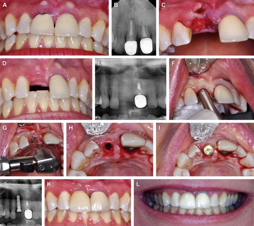 Extraction Socket Grafting and Buccal Wall Regeneration with