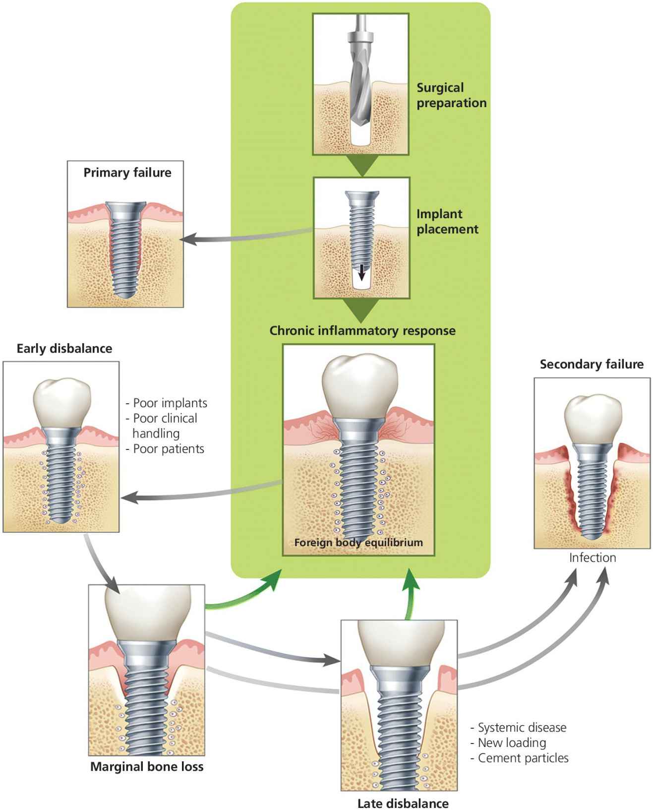 8 Failure in Osseointegration Pocket Dentistry