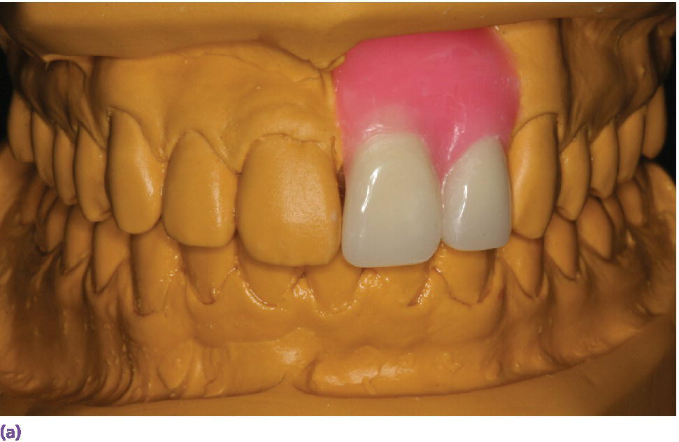 10 Prosthodontic Considerations in the Implant Restoration of the