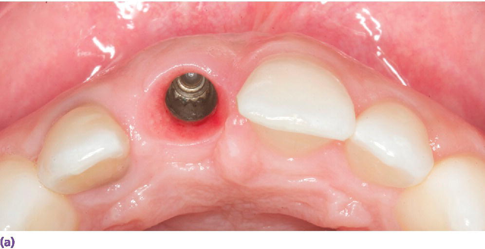 10 Prosthodontic Considerations in the Implant Restoration of the
