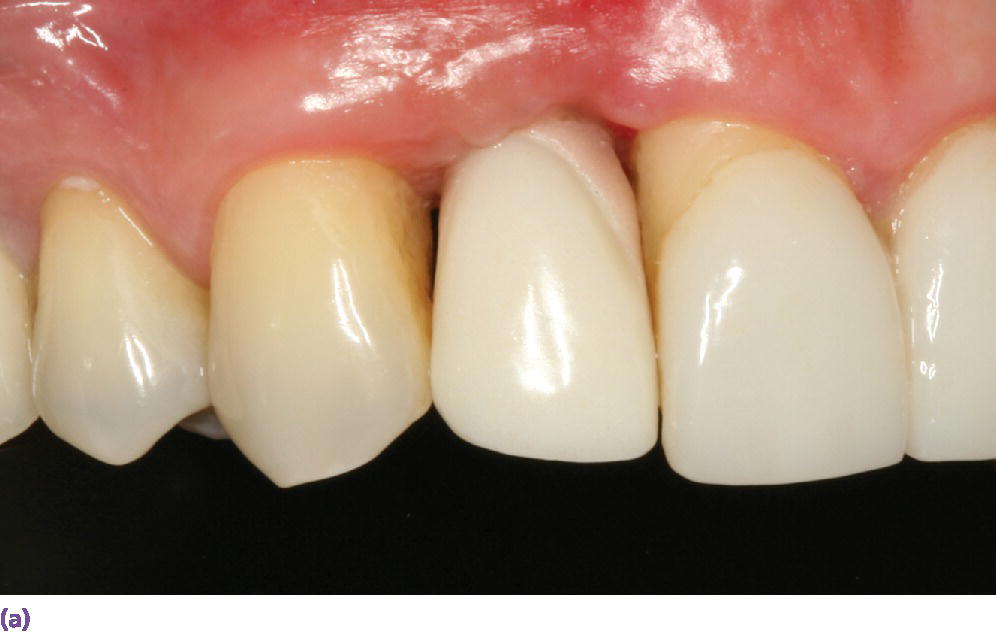 10 Prosthodontic Considerations in the Implant Restoration of the