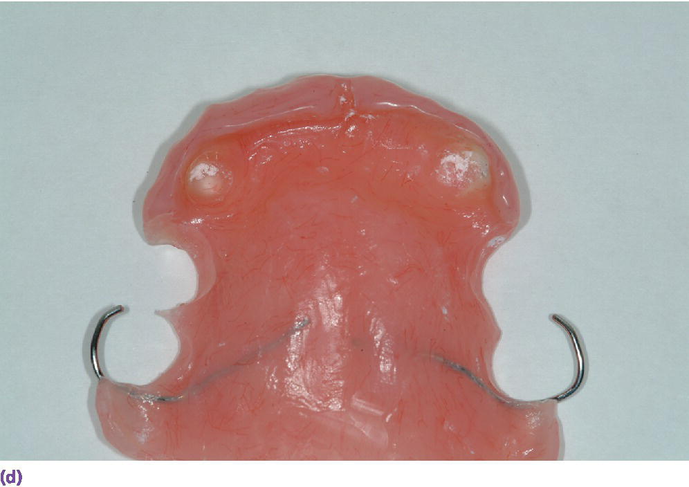 13 Implant Restoration of the Growing Patient Pocket Dentistry