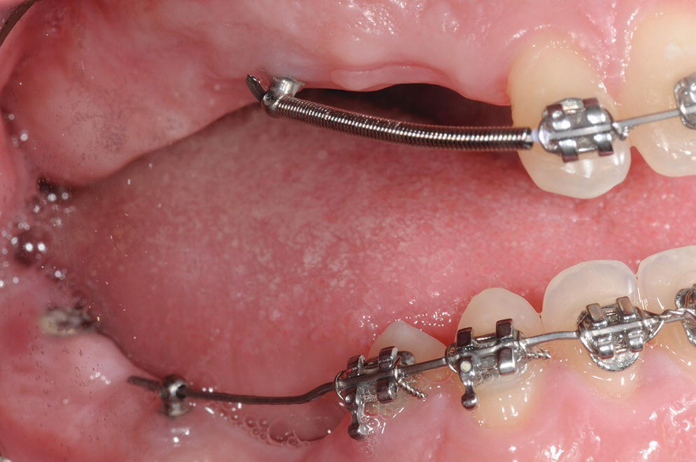 13 Implant Restoration of the Growing Patient Pocket Dentistry
