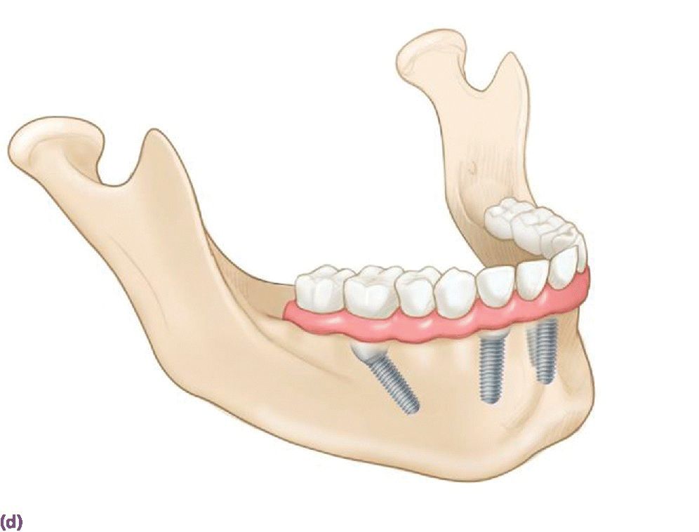 18 Implant Restoration of the Mandibular Edentulous Patient Pocket