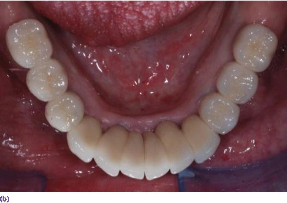 18 Implant Restoration of the Mandibular Edentulous Patient Pocket
