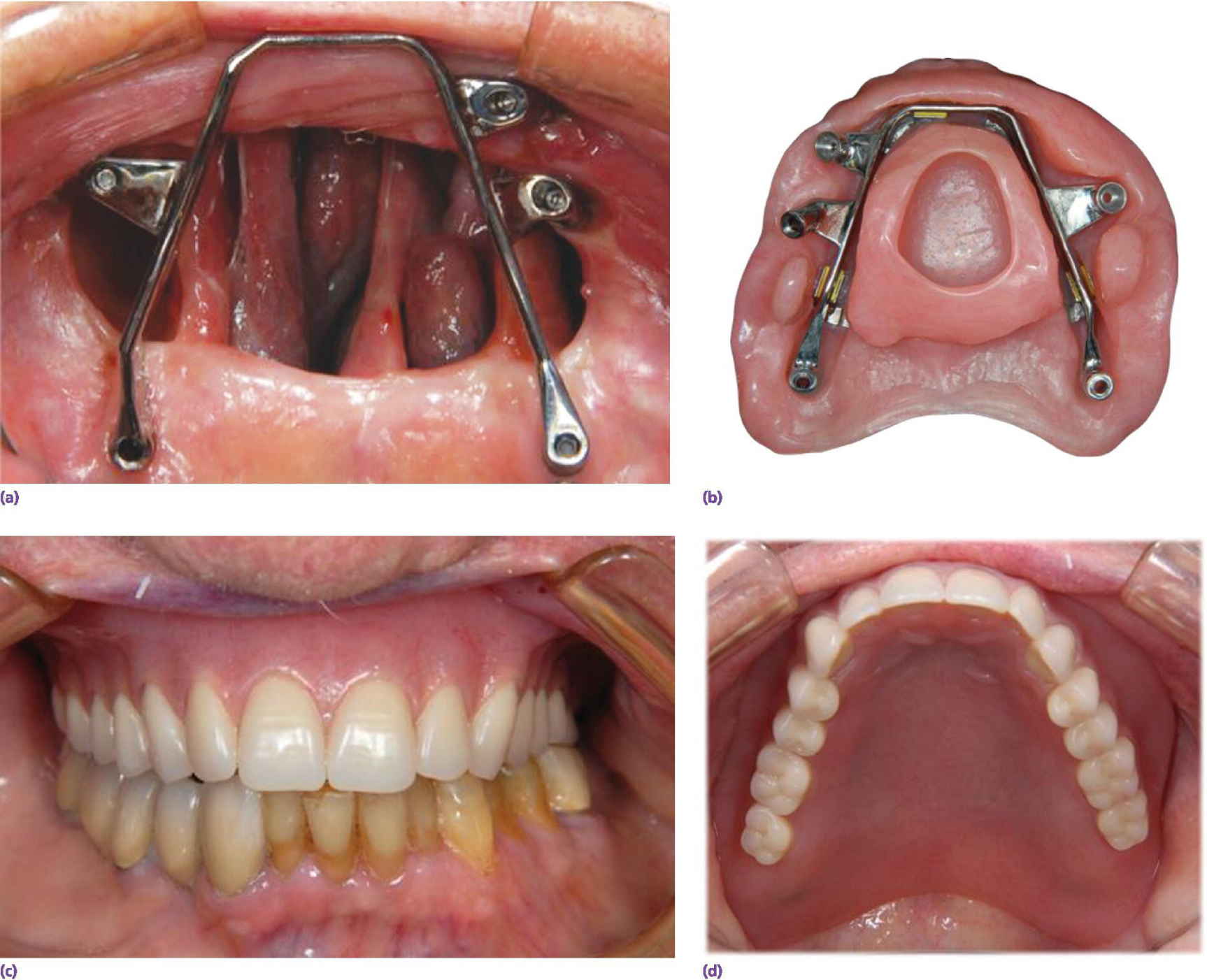 Bone Defect Dental at Leah Grubb blog