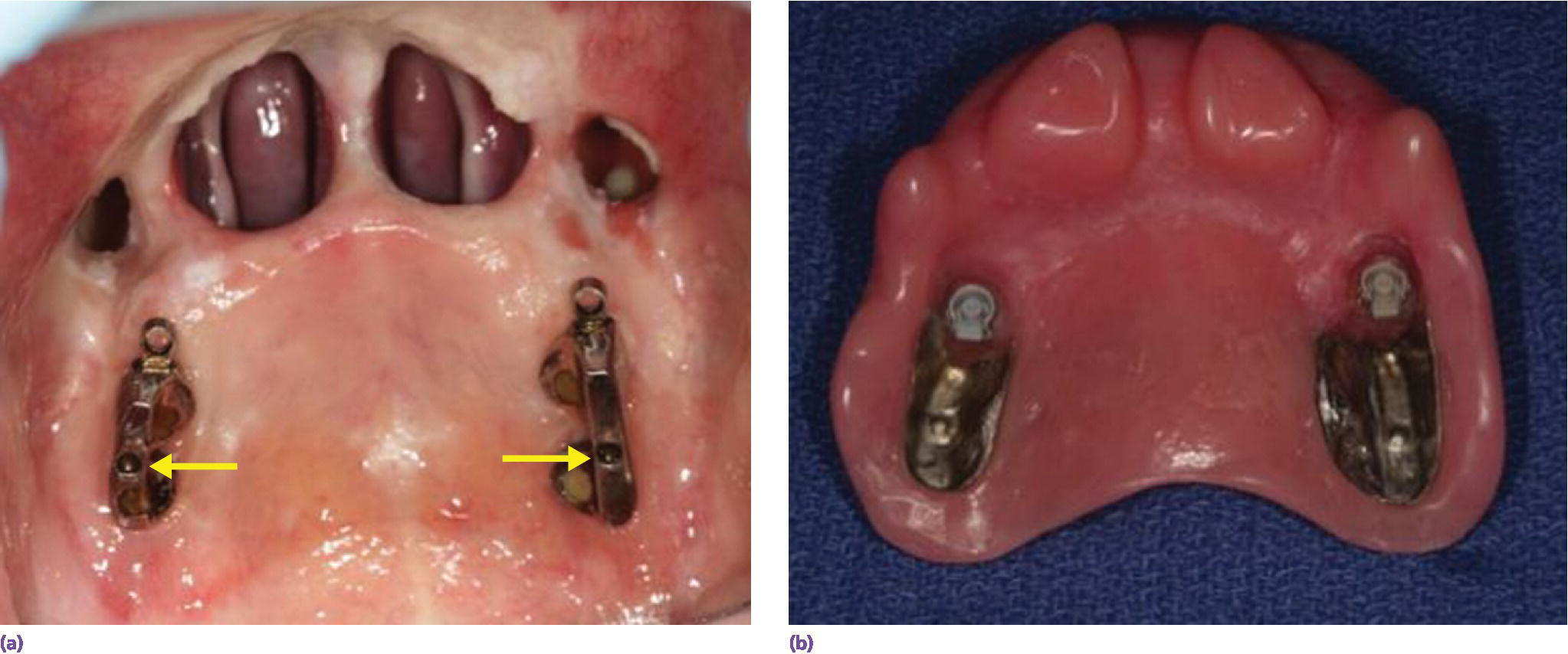 21 Restoration of Acquired Oral Defects with Osseointegrated Implants