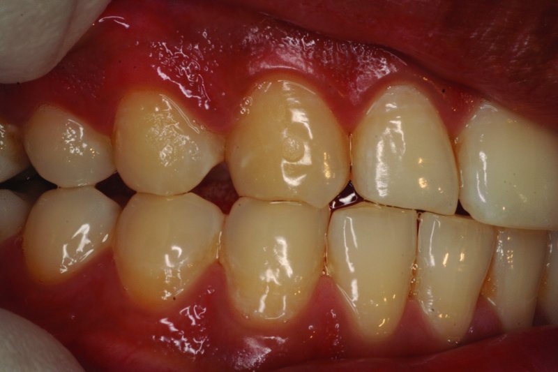 The Direct Canine Rise Restoration Pocket Dentistry