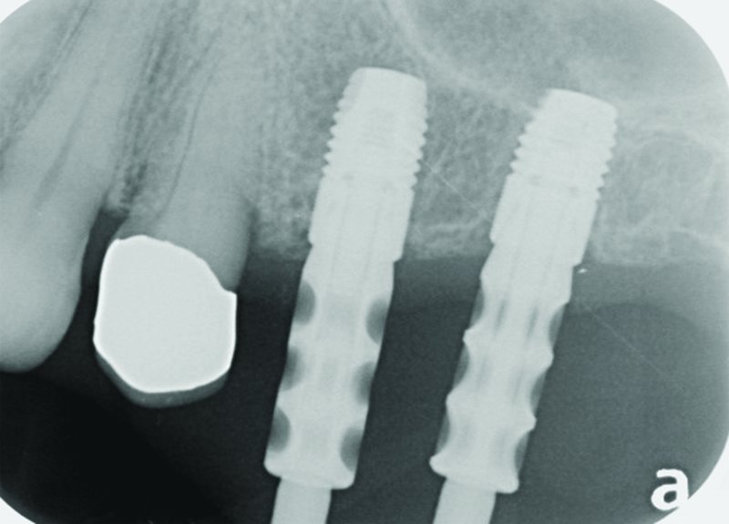 Impression Taking in Implant Dentistry Pocket Dentistry