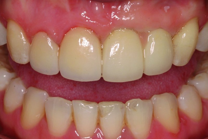 Pink Aesthetics Pocket Dentistry