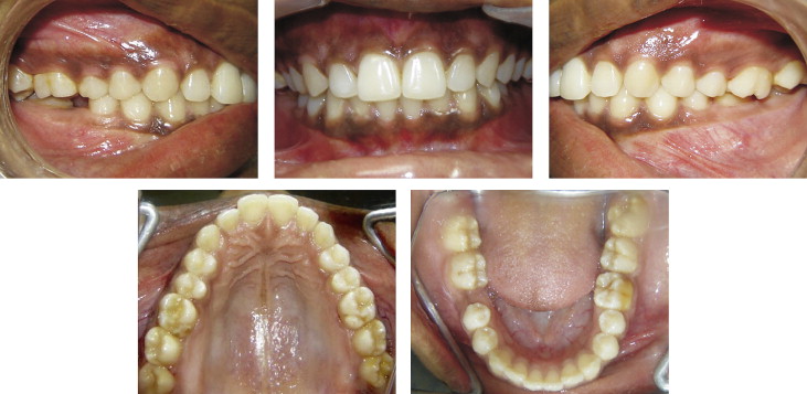 Brodie bite with an extracted mandibular first molar in a young adult