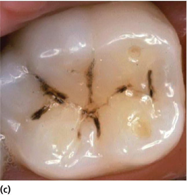 12 Diagnosis and Management of Dental Caries Pocket Dentistry