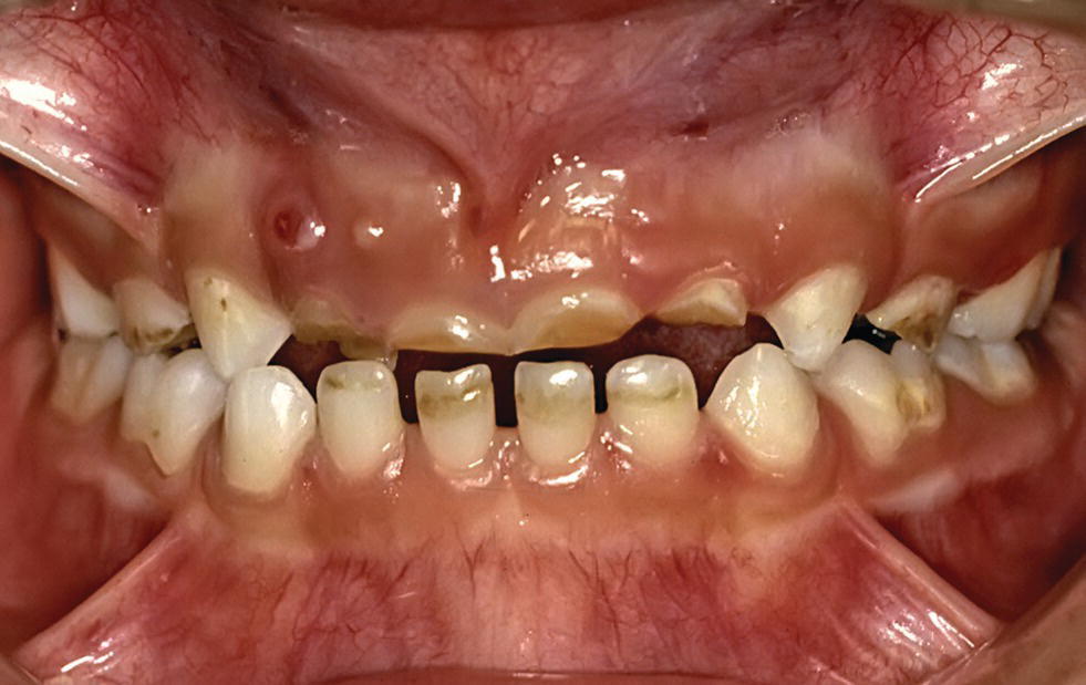 13 Dental Erosion Pocket Dentistry